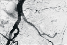 Mobile Angiography Devices